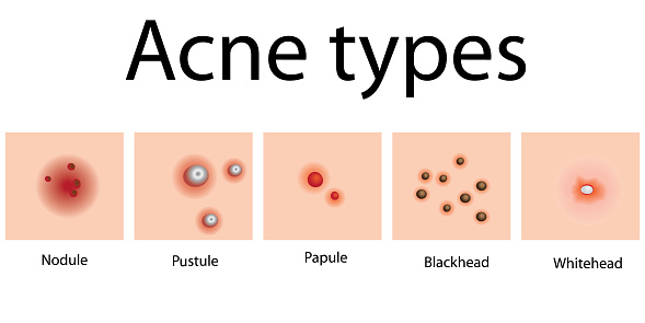 Acne Types Problem Skin Dermatology Stock Illustration - Download Image ...