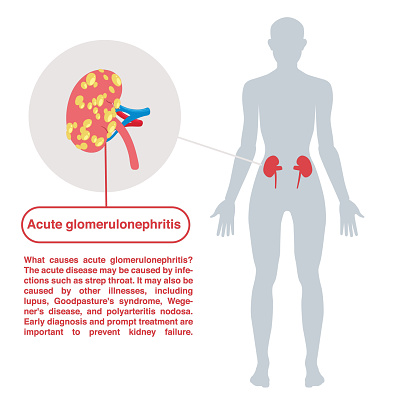 glomerulonephritis diétája