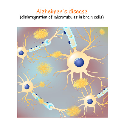 Alzheimer's disease. dementia. Vector Background with neurons and amyloid plaques