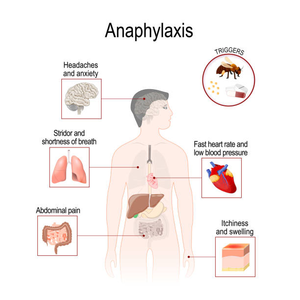 anaphylaxis