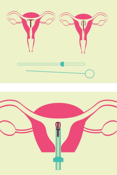 IUD application métodos contraceptivos iud stock illustrations