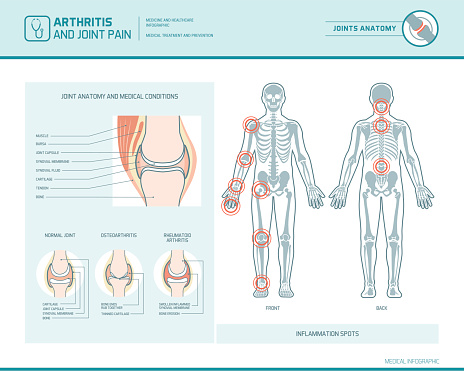 Arthritis and joint pain infographic