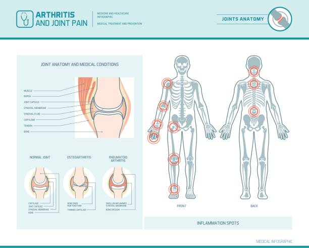 Arthritis and joint pain infographic Rheumatoid arthritis, osteoarthritis and joint pain infographic with inflammation spots and anatomical illustration human joint stock illustrations