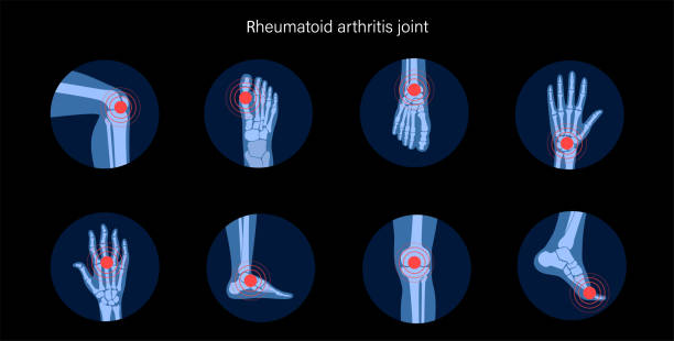 Arthritis Sets 2 Rheumatoid arthritis, pain, bone disease concept. Set with spine, knee, ankle and other joint icons. Inflammation in parts of the human body, anatomical medical poster. Xray flat vector illustration. human joint stock illustrations