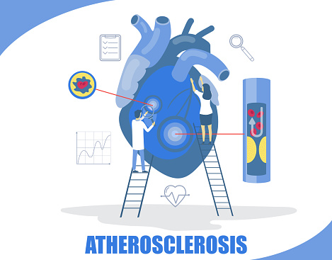 Atherosclerosis concept vector flat style design illustration