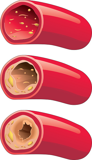 Arteriosclerotic vascular disease, the lumen of artery decreases as a result of the accumulation of fatty materials