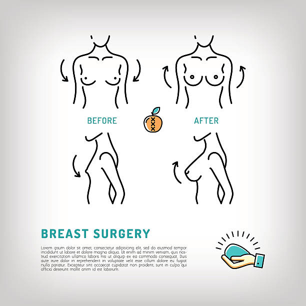 Augmentation Breast plastic surgery icons. Silicone implants, Thin line symbols Augmentation Breast surgery icons, silicone implants. Body Plastic surgery concept thin line icons. Medical symbols and cosmetic surgery before and after. Vector illustration silicone stock illustrations