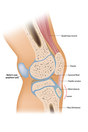 Baker's cyst or popliteal cyst. Traumatology and orthopedics