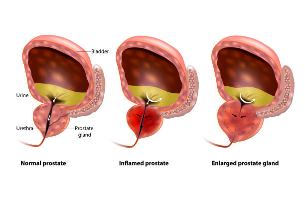 Prostatitis hypoplasia epehólyag és prosztatitis
