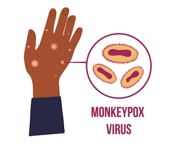 schwarzafrikanische hand mit vielen papeln wegen der affenpockenvirus-ausbruchspandemie. virion-zelldiagramm. - monkeypox stock-grafiken, -clipart, -cartoons und -symbole