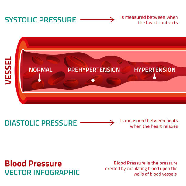 ilustrações, clipart, desenhos animados e ícones de pressão arterial infográfico - hipertensão