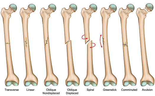 Bone fracture types medical vector illustration