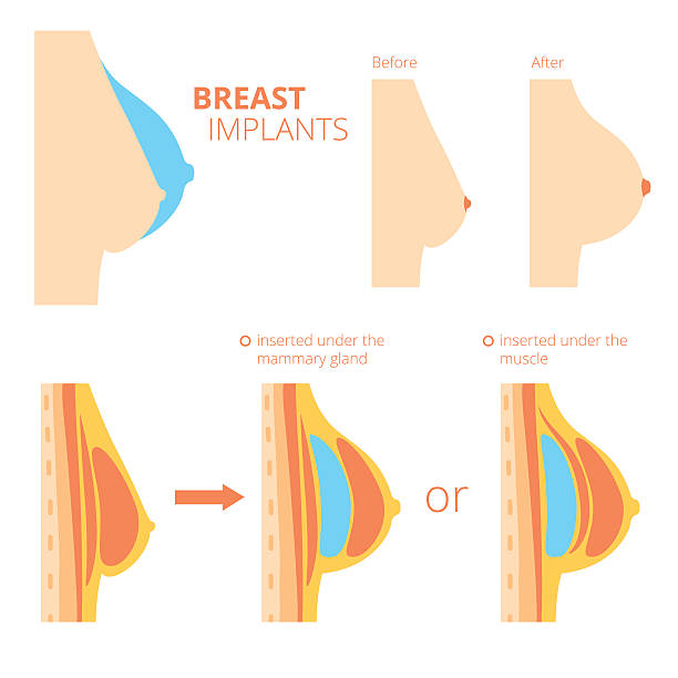 Breast augmentation infographics. Breast augmentation infographics. Breast implants vector illustration silicone stock illustrations