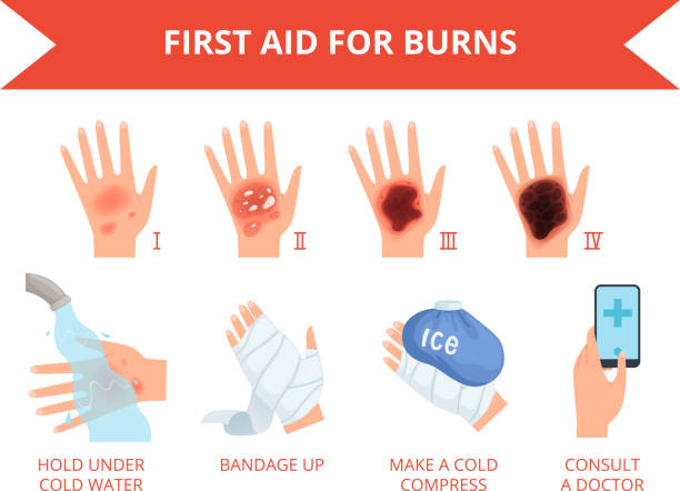 Burn skin. First treatment human hand fire or chemical destruction injury graviera skin safety for persons vector infographics Burn skin. First treatment human hand fire or chemical destruction injury graviera skin safety for persons vector infographic. Injury degree, bandage on damage body, classification illustration burning stock illustrations