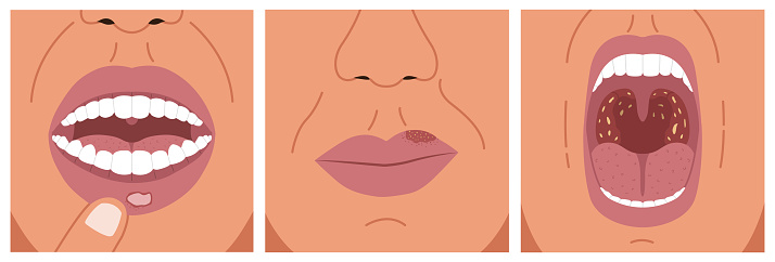 Canker sore, cold sore and sore throat. Vector illustration of aphthous ulcer, herpes and bacterial tonsillitis.