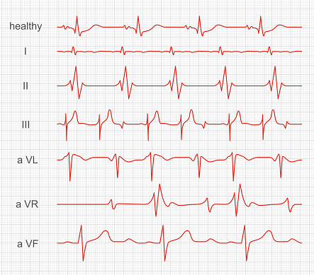 Cardiogram, heart red rhythm on monitor screen