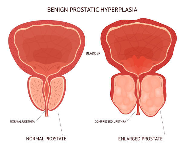 Cartoon Benign Prostatic Hyperplasia Infographics Concept Card Poster. Vector vector art illustration
