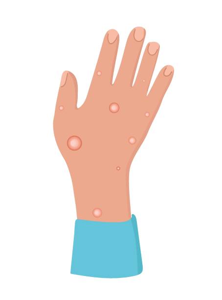 caucasian hand with many papules - monkey pox stock illustrations
