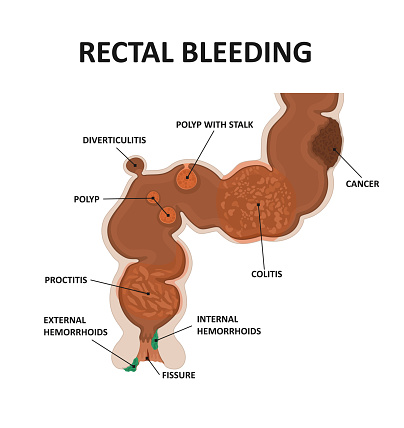 for anal bleeding Cause