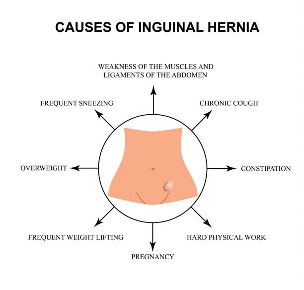 Causes of inguinal hernia. Infographics. Vector illustration on isolated background. Causes of inguinal hernia. Infographics. Vector illustration on isolated background hernia inguinal stock illustrations