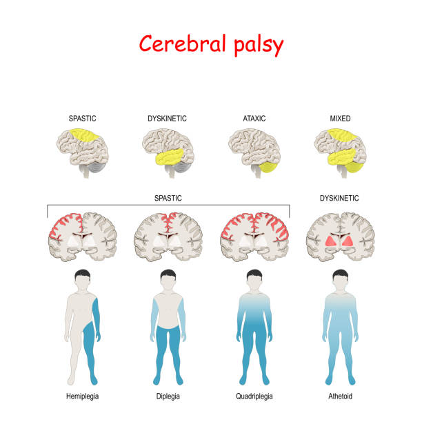 Cerebral palsy. Human brain with area Mixed, Ataxic, Dyskinetic, and Spastic palsy. Cerebral palsy. Human brain with area Mixed, Ataxic, Dyskinetic, and Spastic palsy. Vector diagram for Medical, and educational use.  childhood problem ATAXIC CEREBRAL PALSY stock illustrations