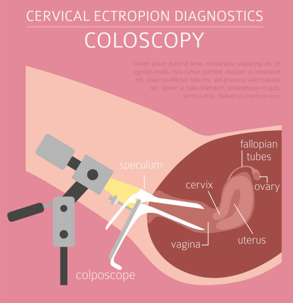 zervikale ektropie. ginecological medical desease infografik - kolposkopie stock-grafiken, -clipart, -cartoons und -symbole
