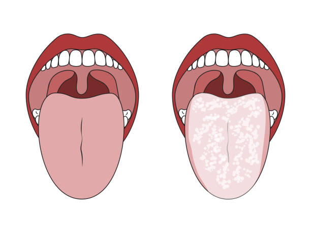 Clean Healthy Tongue and White Coated Tongue. Clean Healthy Tongue and White Coated Tongue. Tongue with Candida Infection. Oral Thrush. human mouth stock illustrations