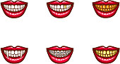 Set of vector red female lips with white healthy teeth and perfect smile, with vampire fangs, with metal dental crowns and implants, with braces. Pop art style illustration. Clipart for dental design