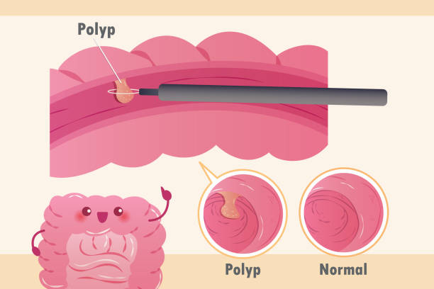 113 Colon Polyp Illustrations &amp; Clip Art - iStock