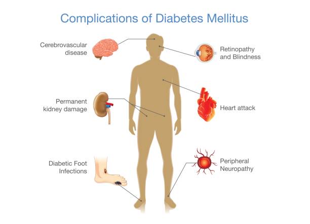 Complications of Diabetes Mellitus. Complications of Diabetes Mellitus in people. Illustration in Infographic style about medical and health. diabetic foot stock illustrations