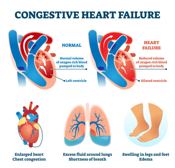 Congestive heart failure vector illustration. Labeled medical compare scheme Congestive heart failure vector illustration. Labeled medical problem vs healthy organ comparison scheme. Illness symptoms infographic with educational dilated ventricle, cardio oxygen supply diagram. failure stock illustrations