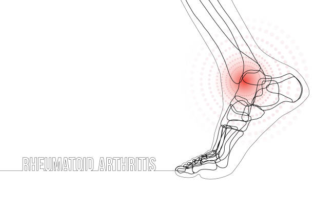Continuous line drawing concept banner about Rheumatoid arthritis White horizontal continuous line drawing concept banner about rheumatoid arthritis. Linear bones joints of foot. For advertising, medical publications in social media. Vector illustration. pain drawings stock illustrations
