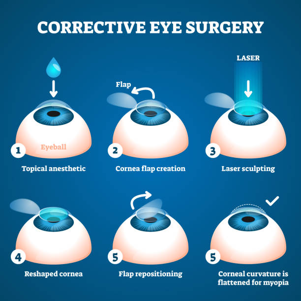 Corrective eye surgery vector illustration. Laser process education scheme. Corrective eye surgery vector illustration. Laser process education scheme. Sight improvement with LASIK technology. Procedure process stages visualization with cornea flap creating and sculpting. eye doctor stock illustrations