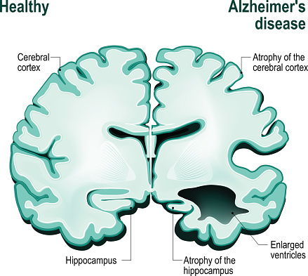 Cross section of the human brain. Healthy brain compared to Alzheimer's disease (dementia, senility)