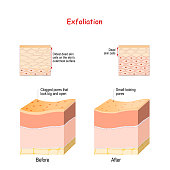 Exfoliation is removal of the old dead skin cells on the skin's outer surface. Cross-section of skin layers before and after Exfoliation. Close-up of epidermal cells.