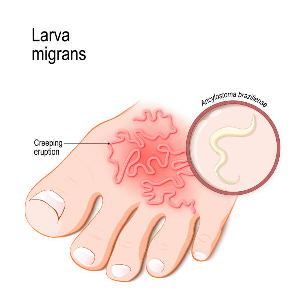 Cutaneous larva migrans. Cutaneous larva migrans. Skin disease in humans caused byhookworm (Ancylostoma braziliense). Vector illustration for medical, biological, science and educational use pics of a tapeworm in humans stock illustrations