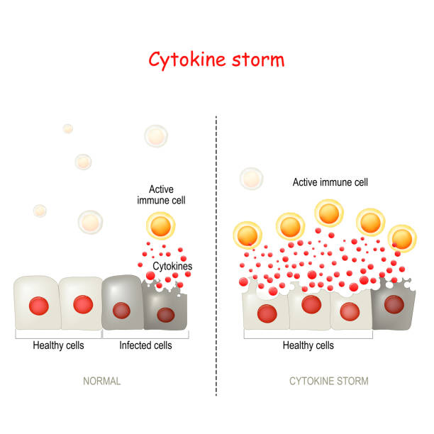 cytokine storm or hypercytokinemia cytokine storm or hypercytokinemia. COVID-19 complications. physiological reaction in which the innate immune system causes an uncontrolled and excessive release of pro-inflammatory signaling molecules (cytokines). Difference and comparison of healthy immune response and cytokine storm storm stock illustrations