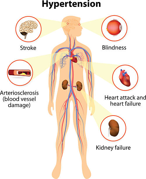 ilustrações, clipart, desenhos animados e ícones de danos de pressão arterial elevada - hipertensão