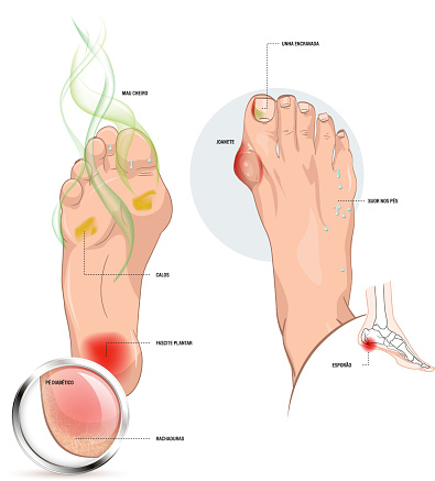 Dealing with foot diseases, diabetic foot, bad smell, calluses, fasceitis, cracks, bunions, ingrown nails, protrusions on feet
