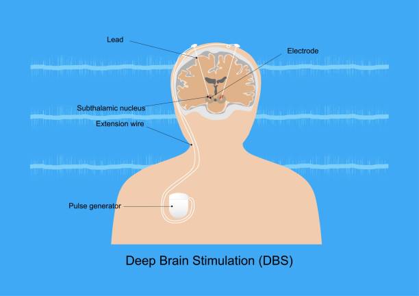 Deep brain stimulation for Parkinson's disease vector art illustration