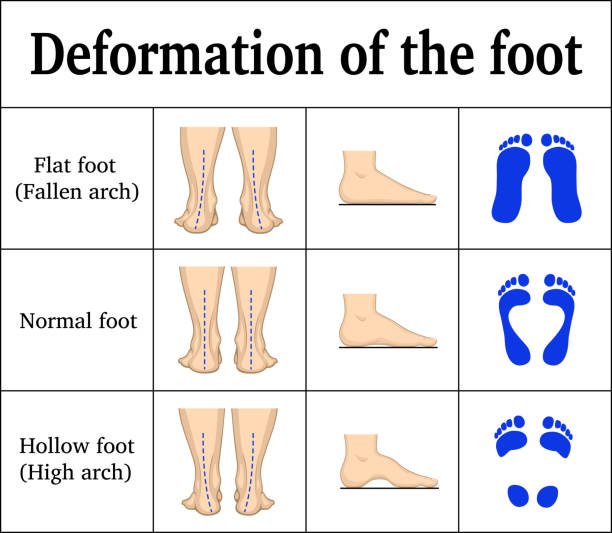 Deformation of the foot Illustration of the deformation of the foot - flat feet and a hollow foot. There are footprints, the form of the foot on the side and behind foot anatomy stock illustrations