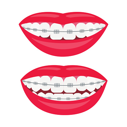 Download Dental Braces Smile With Braces On The Teeth Alignment Of ...