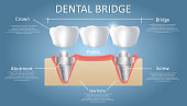 Dental bridge diagram. Vector educational poster, medical infographic. Implant-supported bridge consists of one artificial tooth joined to adjacent dental implants. Fixed dental prosthesis.