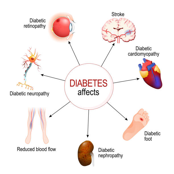 Diabetes Affects. Complications of diabetes mellitus Diabetes Affects. Complications of diabetes mellitus: nephropathy, Diabetic foot, neuropathy, retinopathy, stroke; Reduced blood flow and cardiomyopathy. Vector diagram for educational, medical, biological and science use foot exam diabetes stock illustrations
