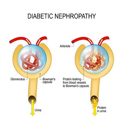 diabete nefropatia)