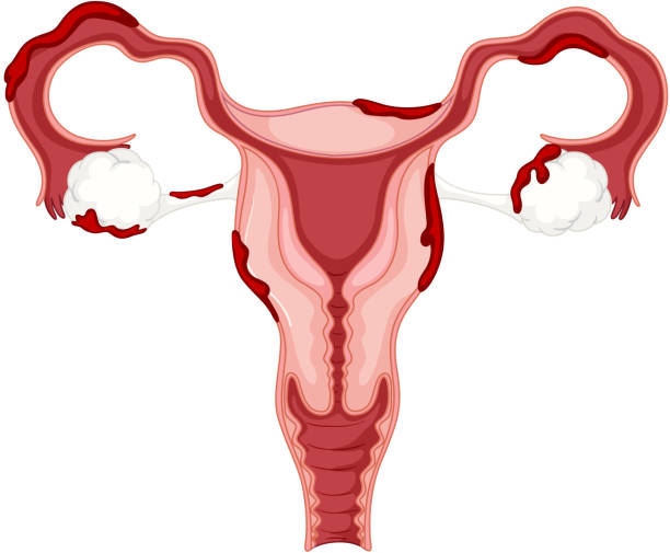 illustrations, cliparts, dessins animés et icônes de diagramme de l’ovaire de la femme atteint d’endométriose - endométriose