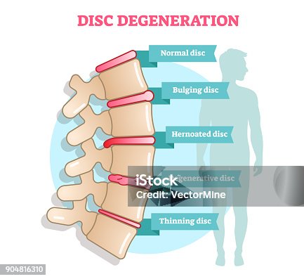 istock Disc degeneration flat illustration vector diagram with condition exampes - bulging, hernoated, degenerative and thinning disc. 904816310
