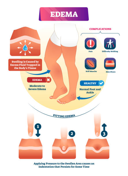 A chart of pregnant woman swollen feet or edema