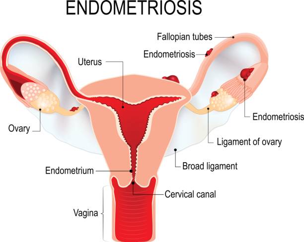 illustrations, cliparts, dessins animés et icônes de endométriose. utérus avec large ligament - endométriose