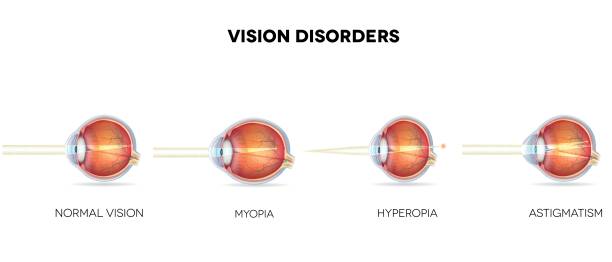 myopia, hyperopia és astigmatizmus)